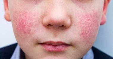 الخد المصفوع.. متلازمة غريبة حذرت منها مراكز السيطرة على الأمراض الخد المصفوع.. متلازمة غريبة حذرت منها مراكز السيطرة على الأمراض