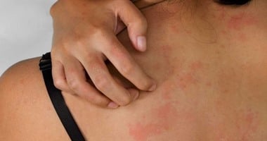 الطفح الجلدى من أعراض فيروس HMPV.. كيف يمكنك الوقاية من المرض؟ الطفح الجلدى من أعراض فيروس HMPV.. كيف يمكنك الوقاية من المرض؟