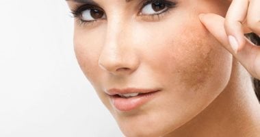 الشمس أم الشاشات.. ما السبب الحقيقى وراء الكلف؟ الشمس أم الشاشات.. ما السبب الحقيقى وراء الكلف؟