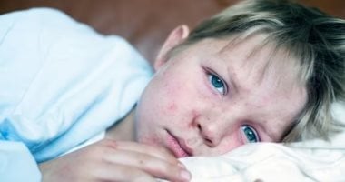 تفشي الحصبة في أمريكا.. ولاية تكساس تسجل حالات بين الأطفال غير المطعمين تفشي الحصبة في أمريكا.. ولاية تكساس تسجل حالات بين الأطفال غير المطعمين