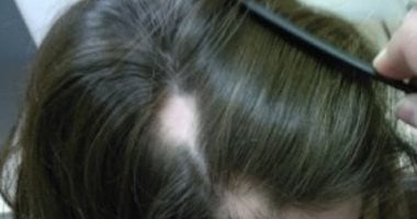 ما هى الثعلبة البقعية.. اعرف أعراضها وطرق علاجها