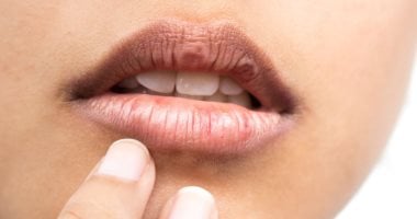 أسباب غير شائعة لتقشر جلد الوجه.. اعرفها