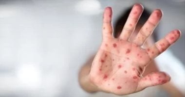 جنوب السودان تعلن تفشى جدرى القرود فى العاصمة جوبا