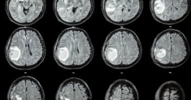 أغرب حكايات الطب.. إزالة جنين من دماغ طفلة أمريكية عمرها عام