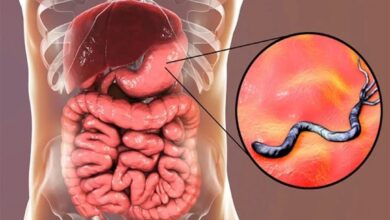 الدكتورة منار حامد : أورام القولون والمستقيم من أكتر أنواع الأورام انتشارا